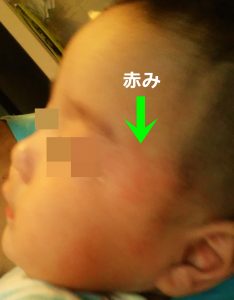 赤ちゃんの顔が赤いので経過を見ていきます 画像あり