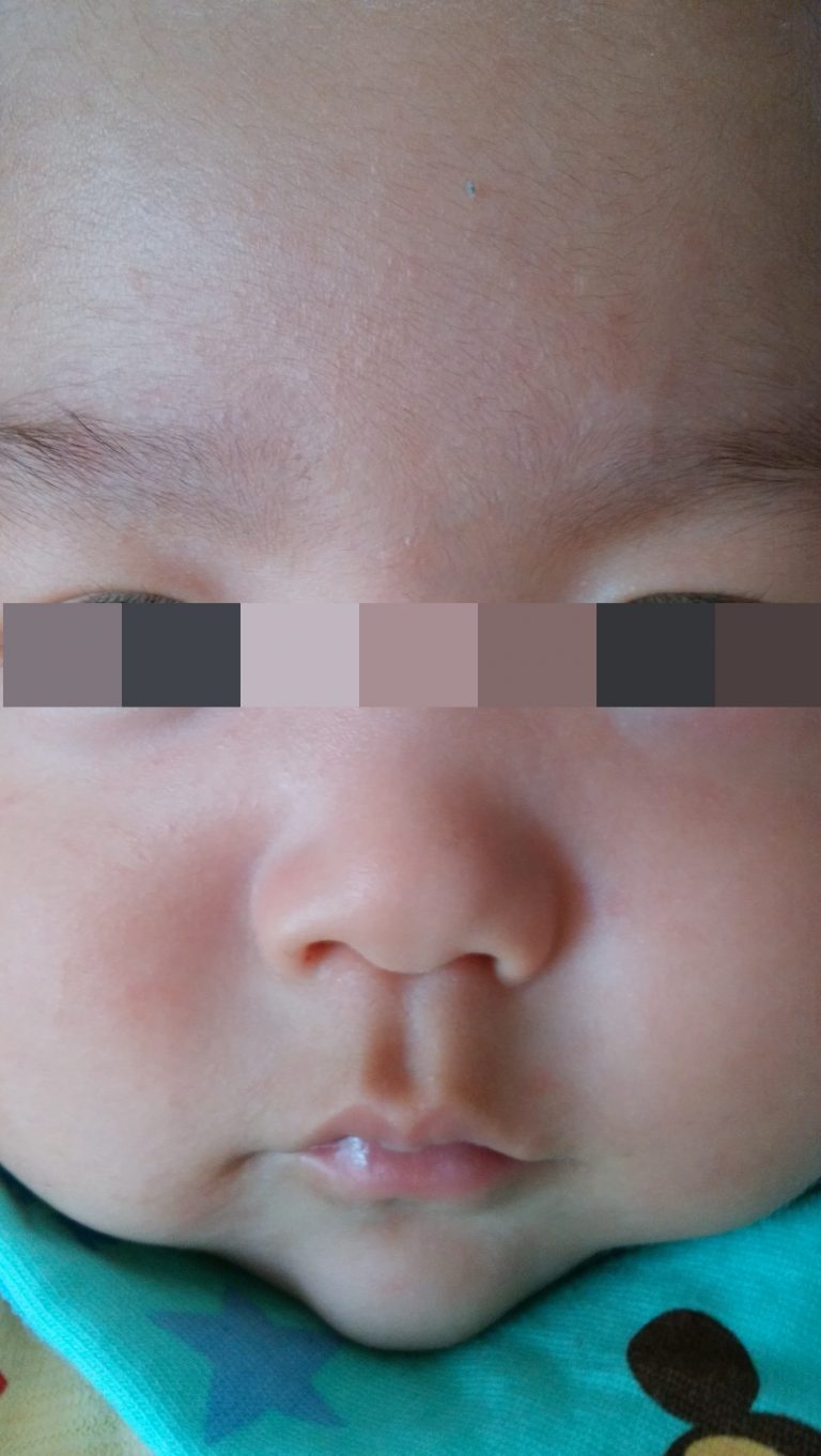赤ちゃんの顔が赤いので経過を見ていきます【画像あり】